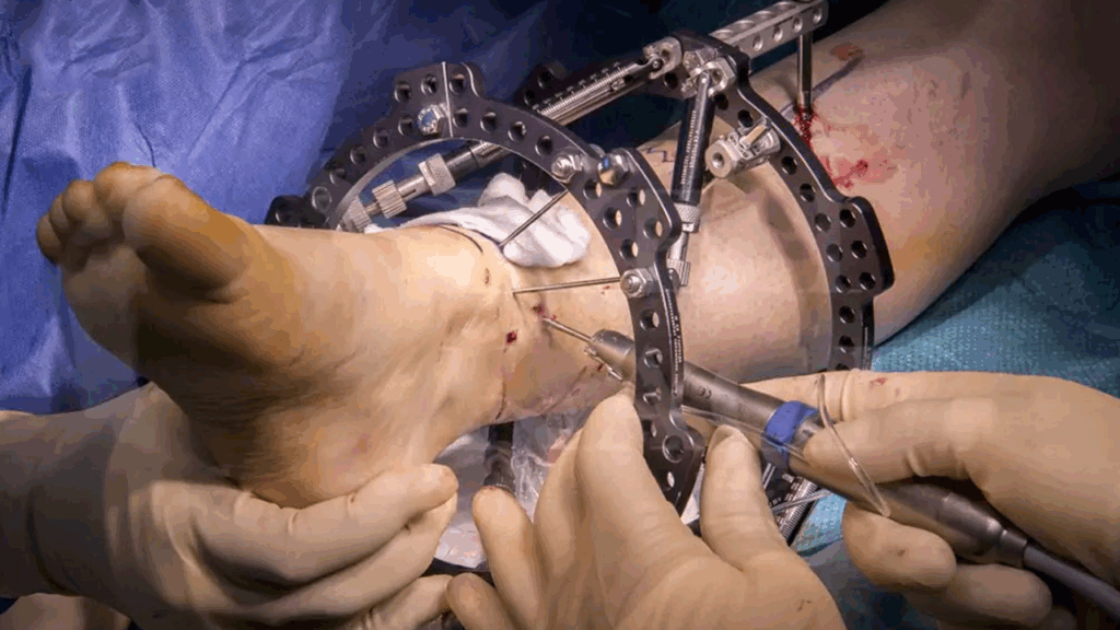 Illizarov Techniques Vishwanath Hospital