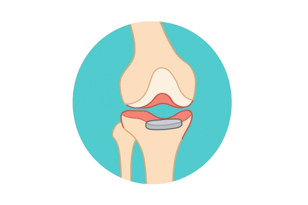 Knee Replacement