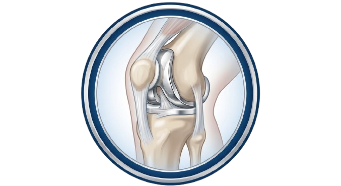 Patellofemoral Partial Knee Replacement